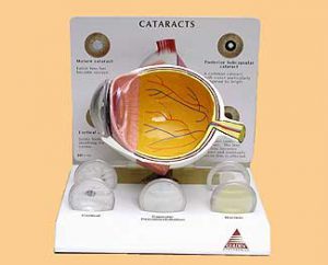 Cataract Eye Model-379